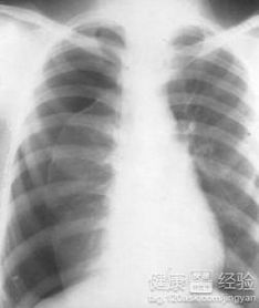 为什么高瘦男性容易得气胸 为什么高瘦男性容易得气胸